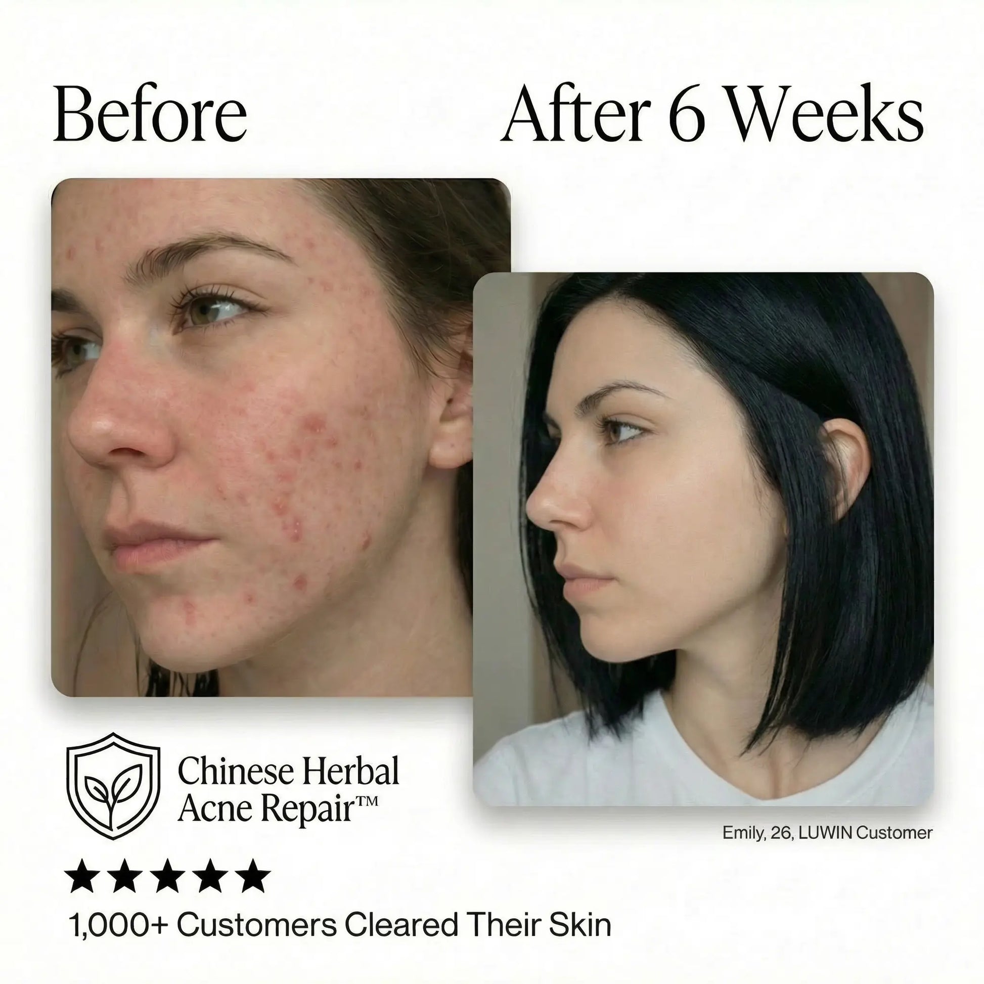 Ultimate Repair & Clear Face Cream for Acne-Prone Skin-2