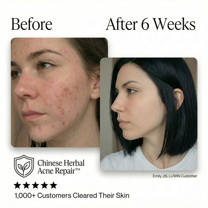 Ultimate Repair & Clear Face Cream for Acne-Prone Skin-2