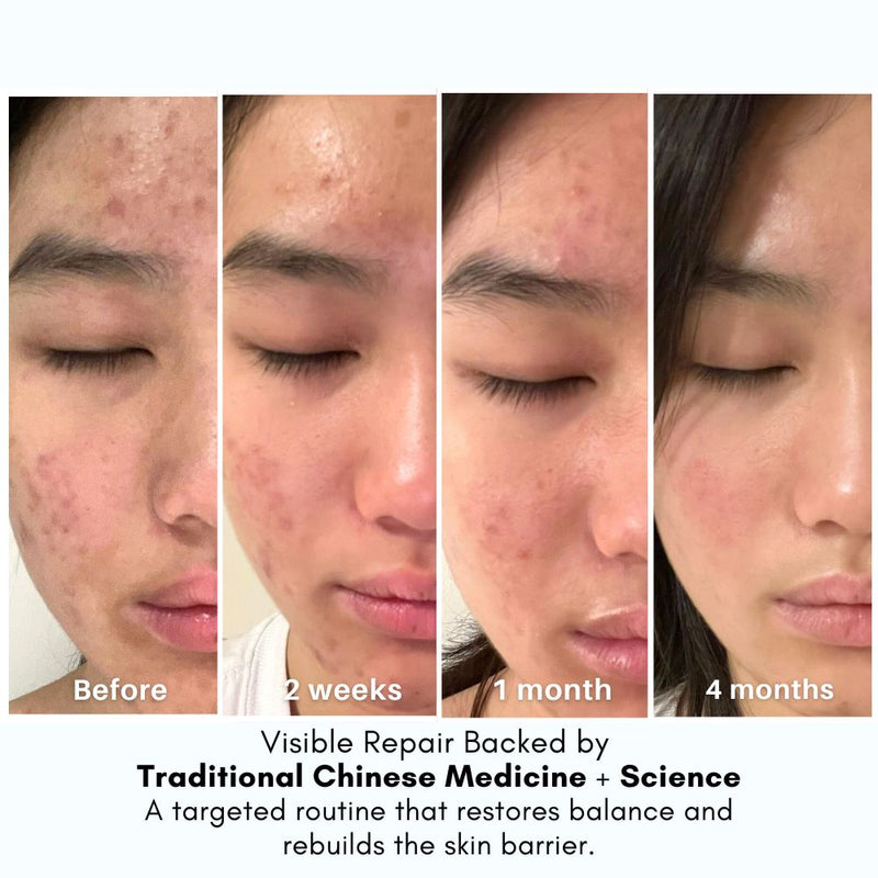 Ultimate Repair & Clear Face Cream for Acne-Prone Skin-8