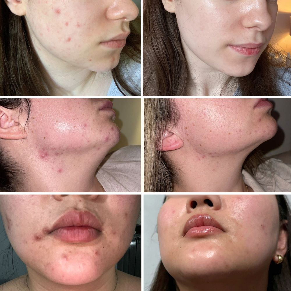 Ultimate Repair & Clear Face Cream for Acne-Prone Skin-12